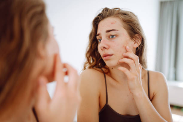 istock Skin Problem. Depressed Woman Touching Pimple On Face Looking At Mirror. 1943286401