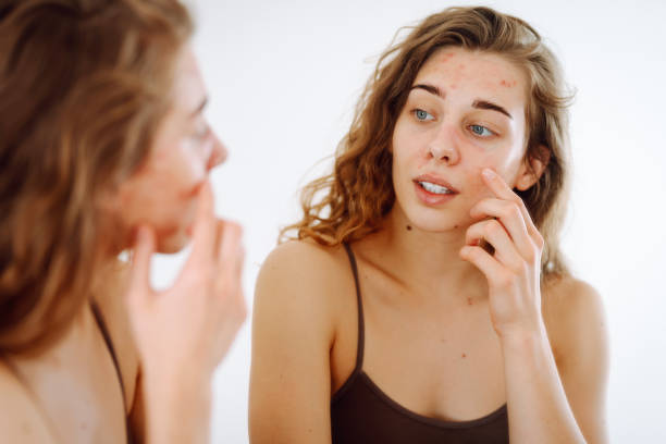 istock Skin Problem. Depressed Woman Touching Pimple On Face Looking At Mirror. 1943286917