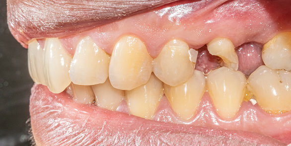 Dental arches in occlusion with a upper premolar decayed and destroyed crown, an unaesthetic resin composite filling, lips and healthy gingival gum.