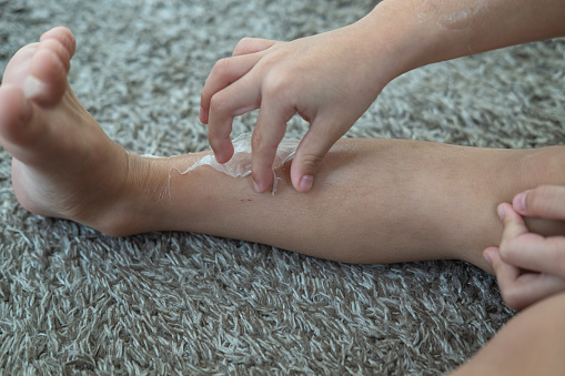 Little Asian boy's hands peeling off dry skin on his legs. Skin problems.