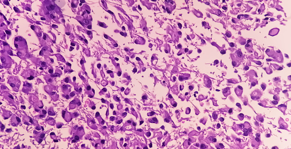 Photomicrograph of Histological analysis of Intramedullary SOL showing Astrocytoma, WHO grade-4