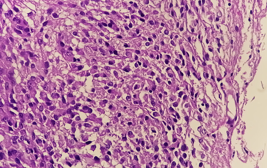 Photomicrograph of Histological analysis of Intramedullary SOL showing Astrocytoma, WHO grade-4