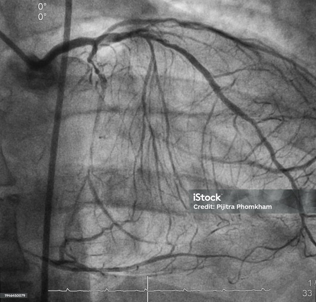 Heart Rupture Angiogram Coronary Angiogram Stock Photo - Download Image Now - Heart - Internal ...