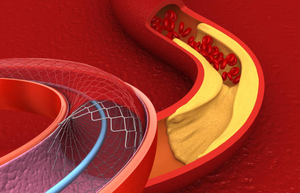 istock Angioplasty and Stent Placement for the Heart 1946925123