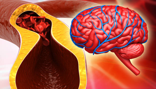 Clogged artery with human brain anatomy Clogged artery with human brain anatomy, brain stroke. 3d illustration Anxiety Disorders INFOGRAPHIC stock pictures, royalty-free photos & images