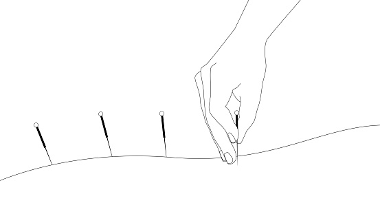Hand of doctor performing acupuncture therapy. Alternative medicine concept,  vector illustration, clip art in black and white outline.