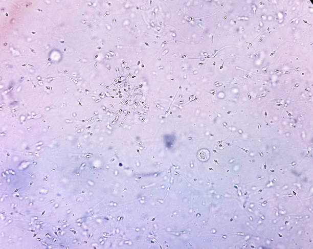 Normozoospermia was analyzed by microscope. Normozoospermia was analyzed by microscope.  Normal semen analysis. staphylococcal enterotoxicosis stock pictures, royalty-free photos & images