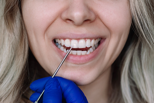 White spot on the tooth enamel. Doctor's hand in a blue glove pointing to young blonde woman's teeth. Dental health care. Dentistry, demineralization of teeth, enamel hypoplasia, pathology, fluorosis