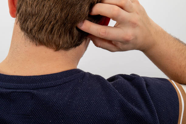 Itching and dandruff A man scratching his scalp, itching because of dandruff. Dandruff falling on his shoulder. Photo shoot from the back. White background dandruff men stock pictures, royalty-free photos & images