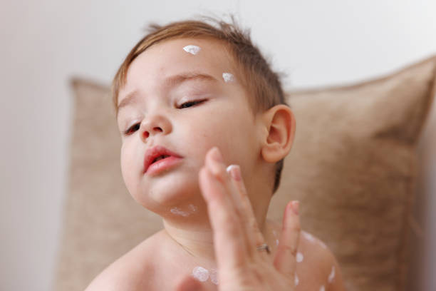 Mother spreading ointment on toddler boy's chickenpox spots to prevent itching and scratching