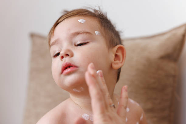 Mother spreading ointment on toddler's chickenpox spots stock photo
