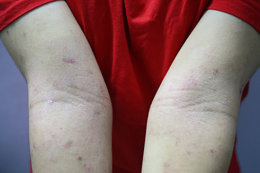 Eczema skin on hand