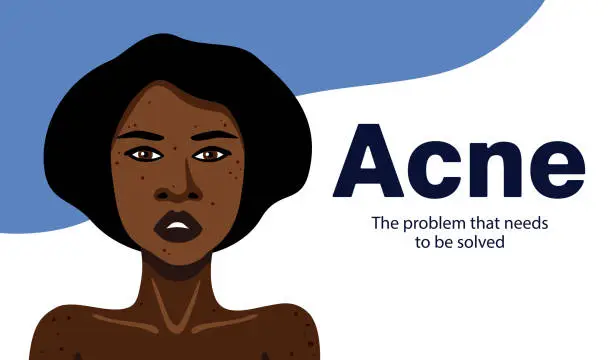 Vector illustration of Acne banner with young African American woman minimalistic illustration