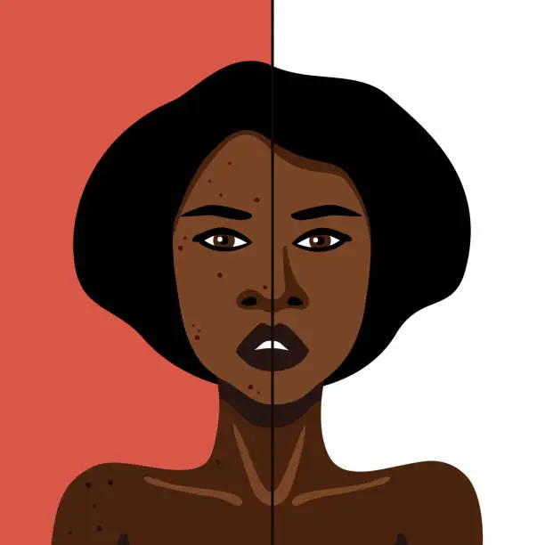 Vector illustration of Vector image of African American woman witn acne on skin treatment minimalistic illustration