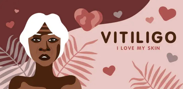 Vector illustration of Banner about vitilingo skin disease with elderly African American woman minimalistic vector