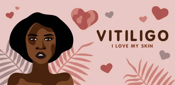 Vector illustration of Banner about vitilingo skin disease with young beautiful African American woman minimalistic vector