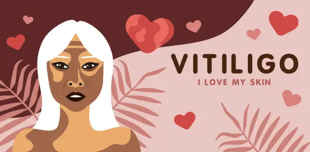 Vector illustration of Banner about vitilingo skin disease with elderly Asian woman, minimalistic vector