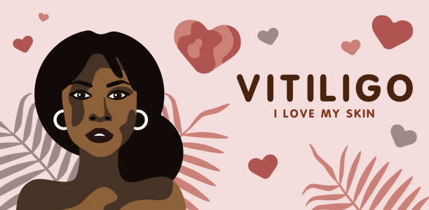 Banner about vitilingo skin disease with young beautiful mulatto woman, minimalistic vector Banner about vitilingo skin disease with young beautiful mulatto woman, minimalistic vector illustration, text I love my skin beautiful mulatto women stock illustrations