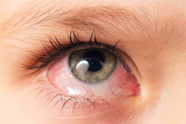 closeup irritated infected red bloodshot eyes, conjunctivitis - conjunctivitis sore eyes child human eye zdjęcia i obrazy z banku zdjęć