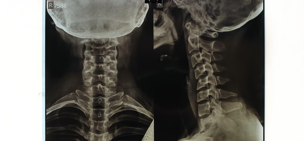 cervical spine xray from xray results of pelvic injury. Real cervical spine xray from hospital. cervical spine xray due to impact