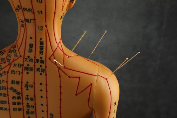 istock Acupuncture - alternative medicine. Human model with needles in shoulder near dark grey background, back view 1954370045