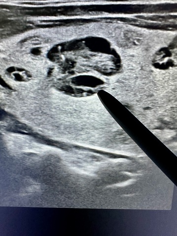 Sonography examination of cystic thyroid nodule showing the solid nodule embedded in normal thyroid tissue