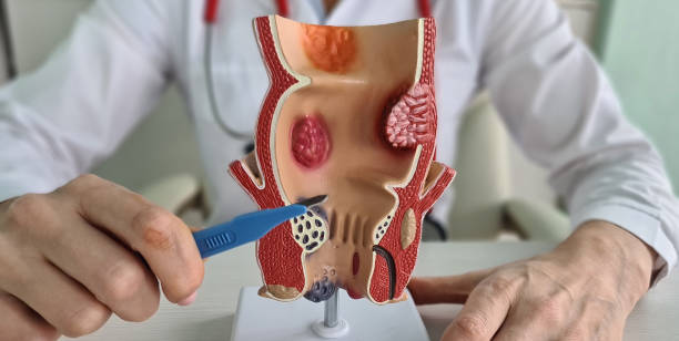 istock Preparation for surgery to remove hemorrhoids closeup 1954950166