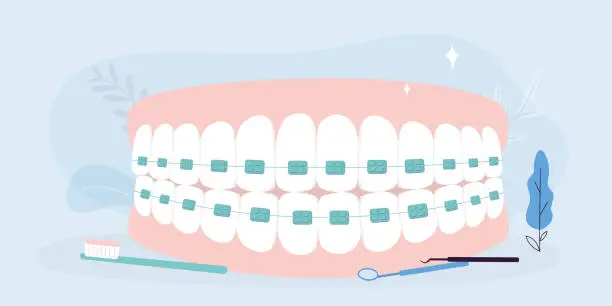 Vector illustration of Teeth with braces upper and lower jaw. Alignment of the bite of teeth, dentition with braces, dental braces and tools. Medical banner. Oral care