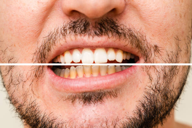 istock Man's teeth before and after whitening and alignment (braces). Oral care 1957245326