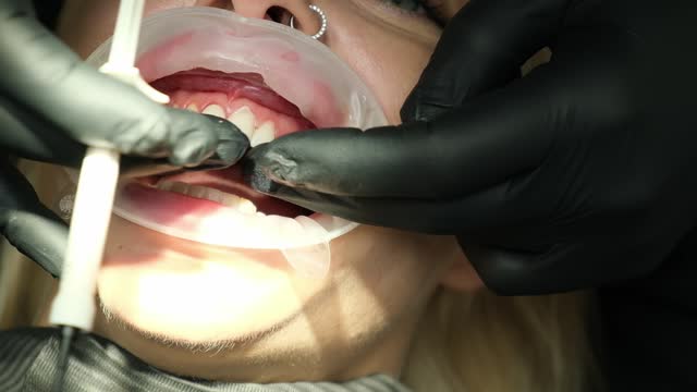 A dentist installs a veneer on a girl patient. Modern dentistry. Close-up.