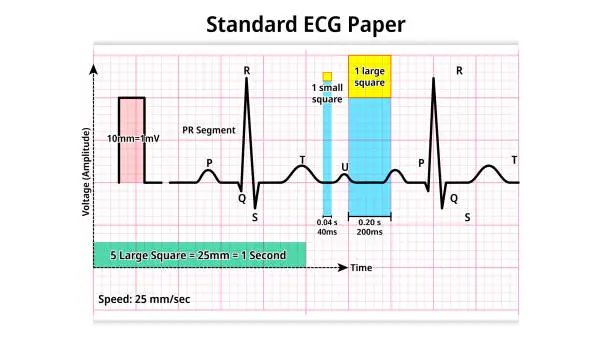 Vector illustration of Standard ECG Paper - grid of squares that moves at a speed of 25 mm per second and a voltage of 10 mm per miliVolt