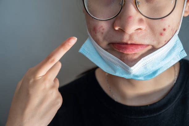 vue recadrée de la femme ouvrant son masque et pointant le problème d’acné se produisent sur sa peau en raison du port du masque pendant longtemps. - longtime photos et images de collection