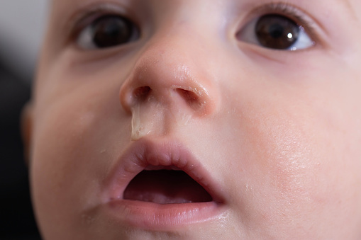 Yellow snot from a child s nose, close-up. Sinus infections, colds and virus. Chronic runny nose