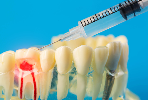 Injection of an anesthetic drug into the gum of a diseased tooth for treatment and surgery. Dental anesthesia in dentistry, freezing, macro. Copy space for text, painkiller