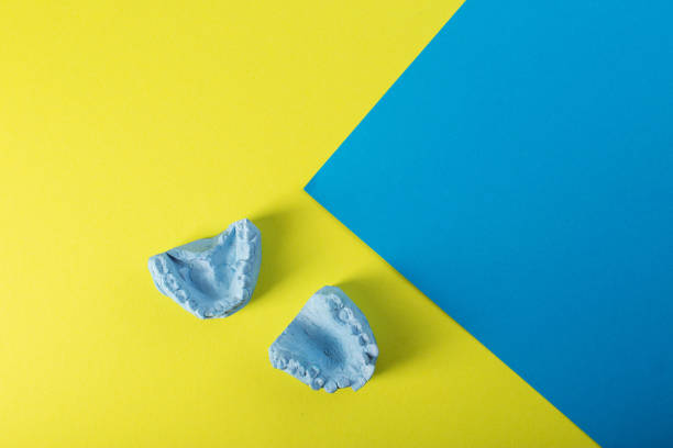 Blue plaster impression of a patient's dental jaw with crooked teeth and malocclusions on a yellow and blue background. Manufacturing of bridges, crowns of various types., macro. Copy space for text impresión de yeso azul de la mandíbula dental de un paciente con dientes torcidos y maloclusiones sobre un fondo amarillo y azul. fabricación de puentes, coronas de varios tipos., macro. espacio de copia para texto, disposición de los dientes
