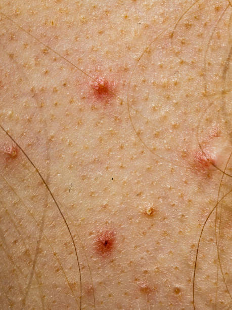 istock Closeup skin with acne moles and red spots. 1960717737