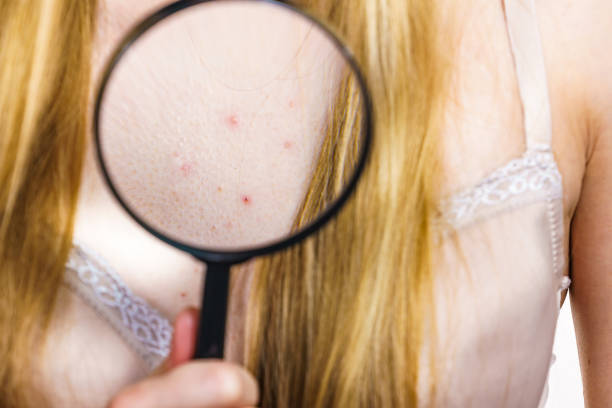 istock Woman with skin problem acne on neckline 1960726565