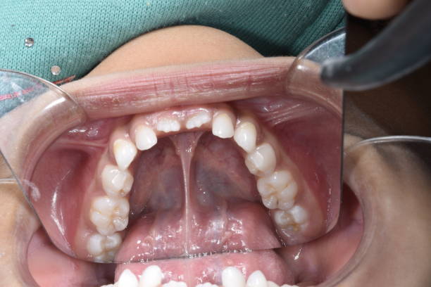 istock Lower mandibular arch occlusal indirect mirror view 1963634385