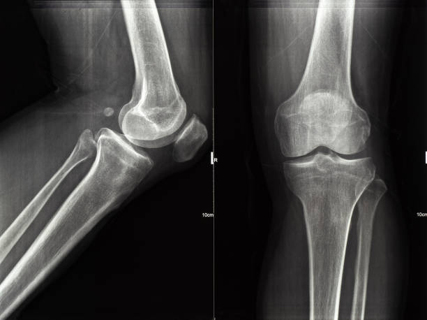 istock Human Leg and Knee X-Ray Image 1964977533