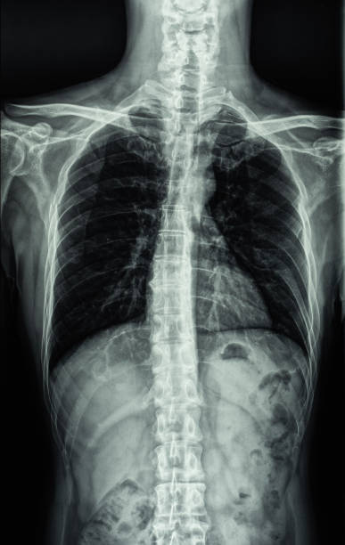 chset xray film of a patient with active pulmonary tuberculosis with cavitation in the right upper lung