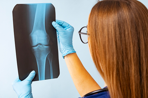 Healthcare worker examining an X-ray film of a knee joint, focusing on the details for medical diagnosis and treatment.