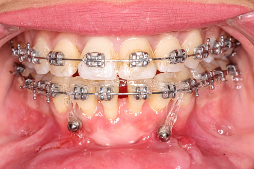 Orthodontic braces with diastema gap between lower central incisors and periodontal disease gingiva gum recession. Mini-implants in the lower mandible
