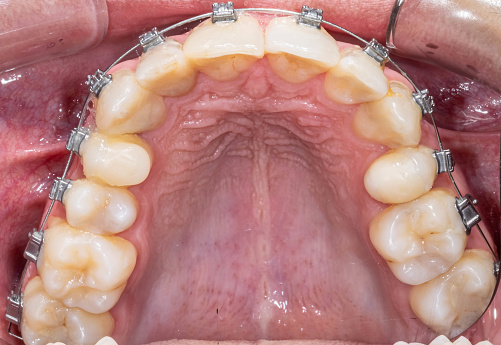 Indirect occlusal view with buccal photography mirror. Teeth alignement treatment with dental braces and metallic wire. Cheeks and lips retracted with cheek retractor.
