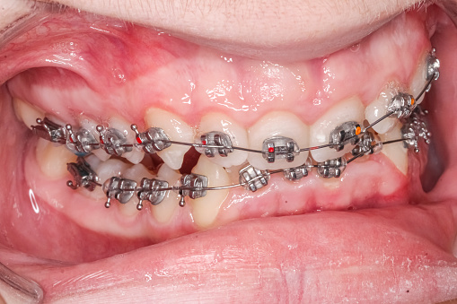 Orthodontics braces, arch wire, crooked teeth, cheeks and lips retracted with cheek retractor.