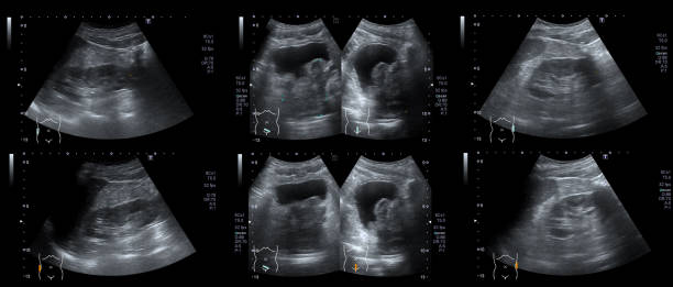 imágenes radiográficas de vejiga urinaria o vejiga y próstata, glándula o próstata para comprobar enfermedades prostáticas o hiperplasia prostática. - cat scan abdomen medical scan x ray fotografías e imágenes de stock