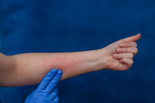 Hand with allergic irritation, red skin of the forearm isolated