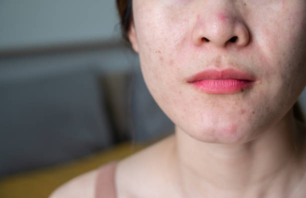 istock Cropped shot view of woman face with acne problem. 1969013232