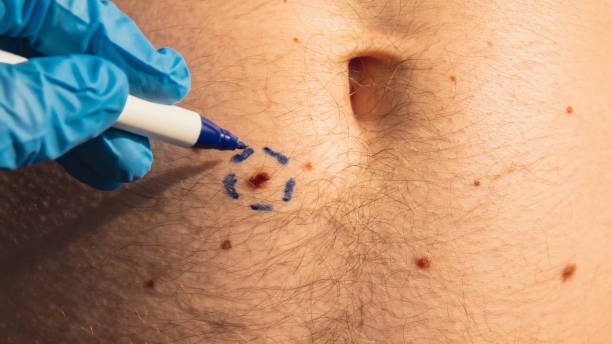 Preparing procedure for medical skin surgery. Unrecognizable Doctor in medical gloves paint lines around male birthmarks. Laser skin tags removal. Prevention of melanoma and nevus exam. Pigmentation procedimiento de preparación para la cirugía médica de la piel. un médico irreconocible con guantes médicos pinta líneas alrededor de las marcas de nacimiento masculinas. eliminación de papilomas cutáneos con láser. examen de prevención de melano