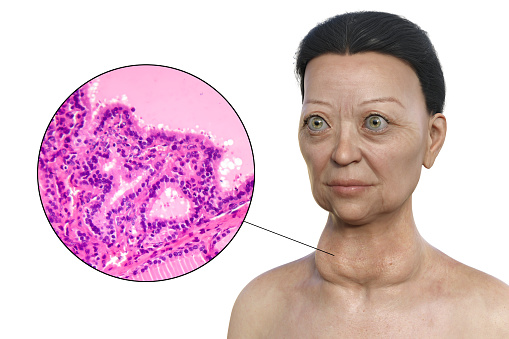A 3D illustration of a woman with Graves' disease having enlarged thyroid gland and exophthalmos, alongside a micrograph image of thyroid tissue affected by Graves' disease.