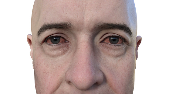Conceptual 3D illustration portraying a person with dry eyes, a condition marked by insufficient tear production causing discomfort and irritation.